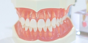 義歯（入歯）